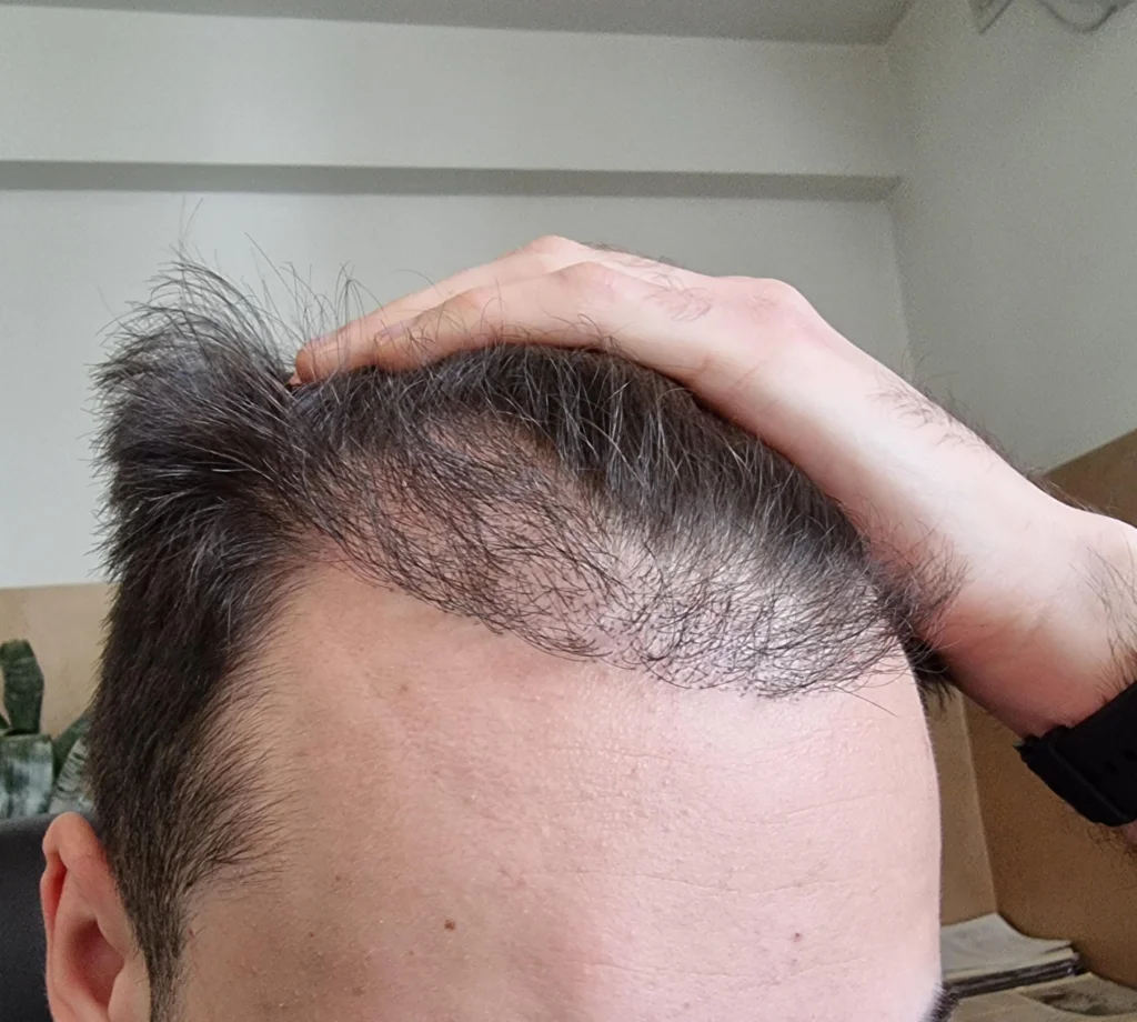 DHT on Hair