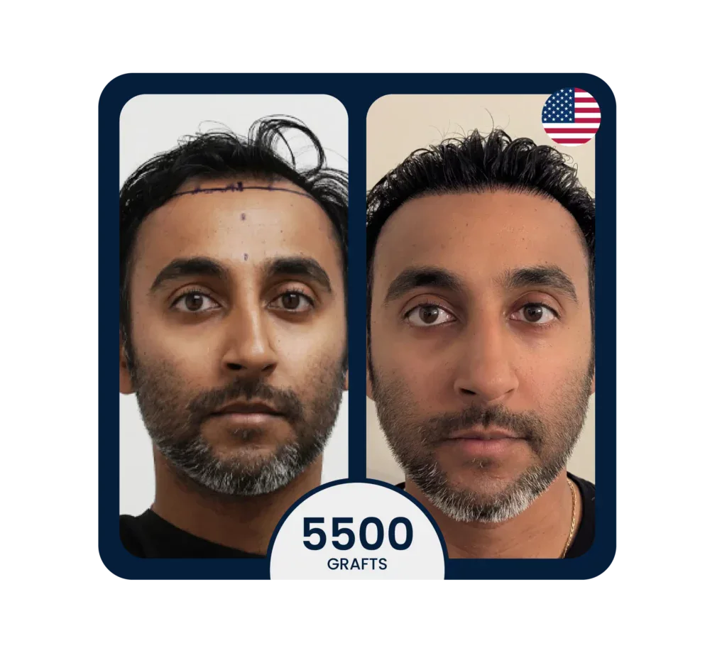 DHI Hair transplant before after for 5500 graft, male