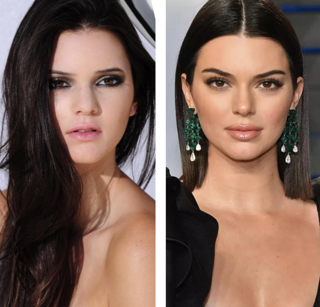 Kendall Jenner Plastic Surgery Journey Exploring the Rumors and Realities