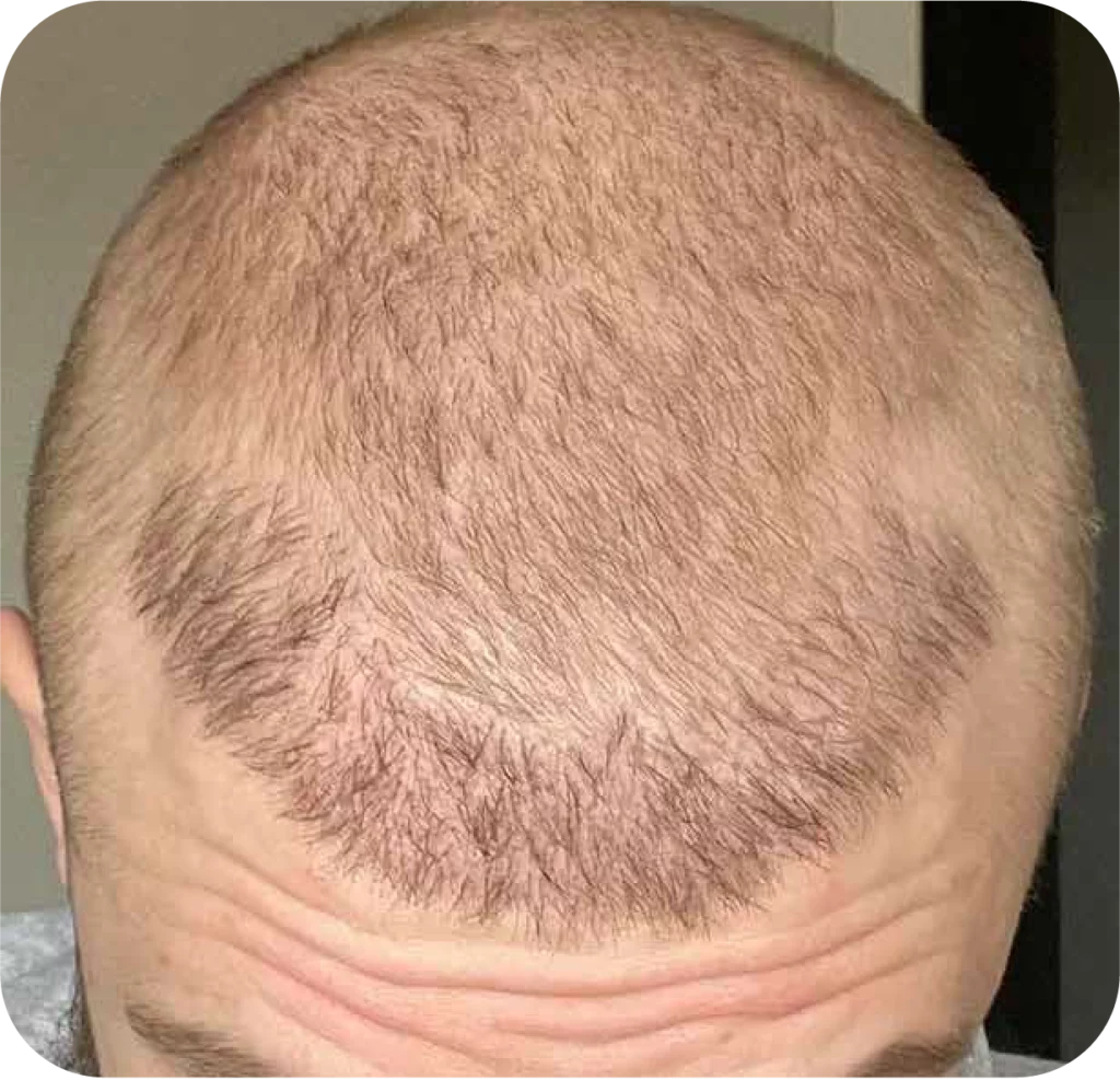 hair transplant turkey