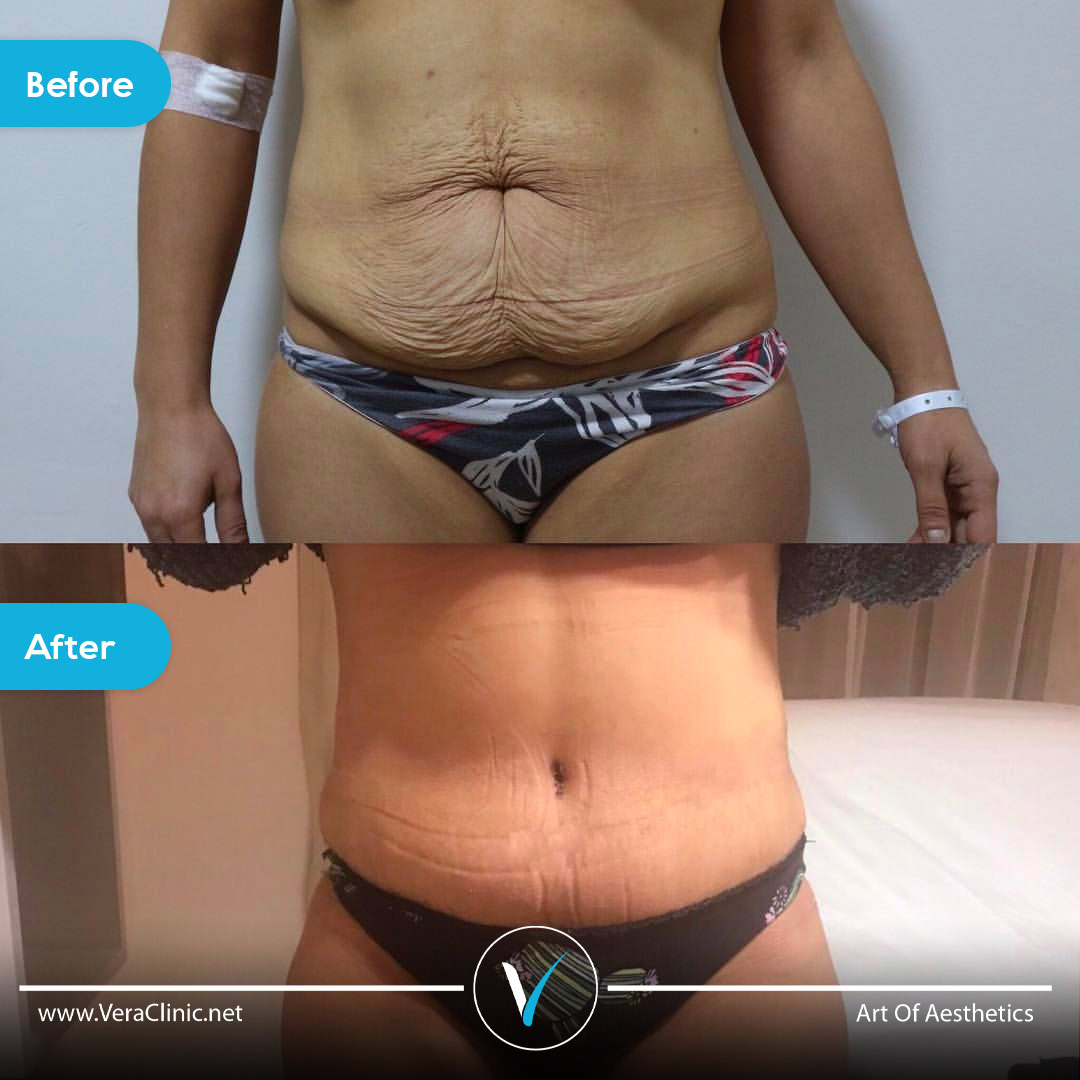 Tummy tuck