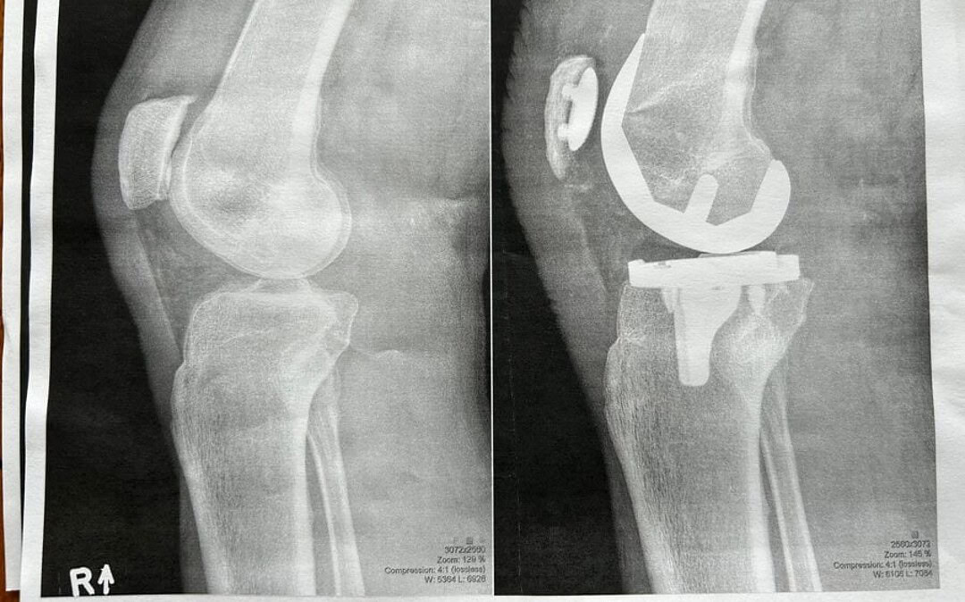 Total Knee Replacement Journal