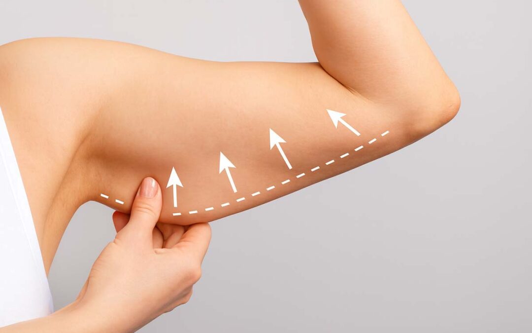 Why can an upper arm lift be a suitable post‐bariatric treatment?