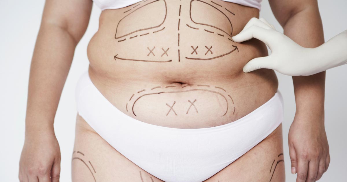 Liposuction Cost for Men vs Women in South Africa — What’s the Difference?
