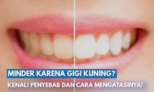 Gigi Tiba-Tiba Kuning Padahal Rajin Sikat Gigi? Ini Penyebab yang Sering Terlewat