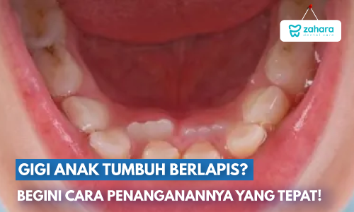 Gigi Anak Tumbuh Berlapis? Jangan Panik, Beginilah Penanganannya yang Tepat