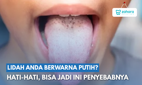 6 Penyebab Lidah Berwarna Putih dan Cara Mengatasinya