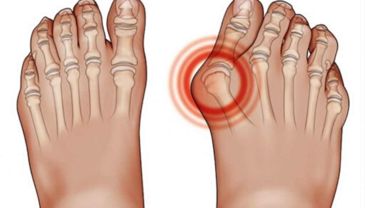 chirurgia-del-piede-alluce-valgo-anatomia