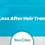 Shock Loss After Hair Transplant