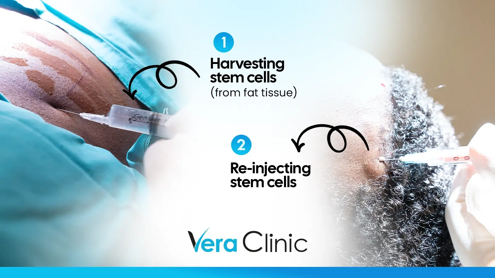 Stem cells stimulates hair growth