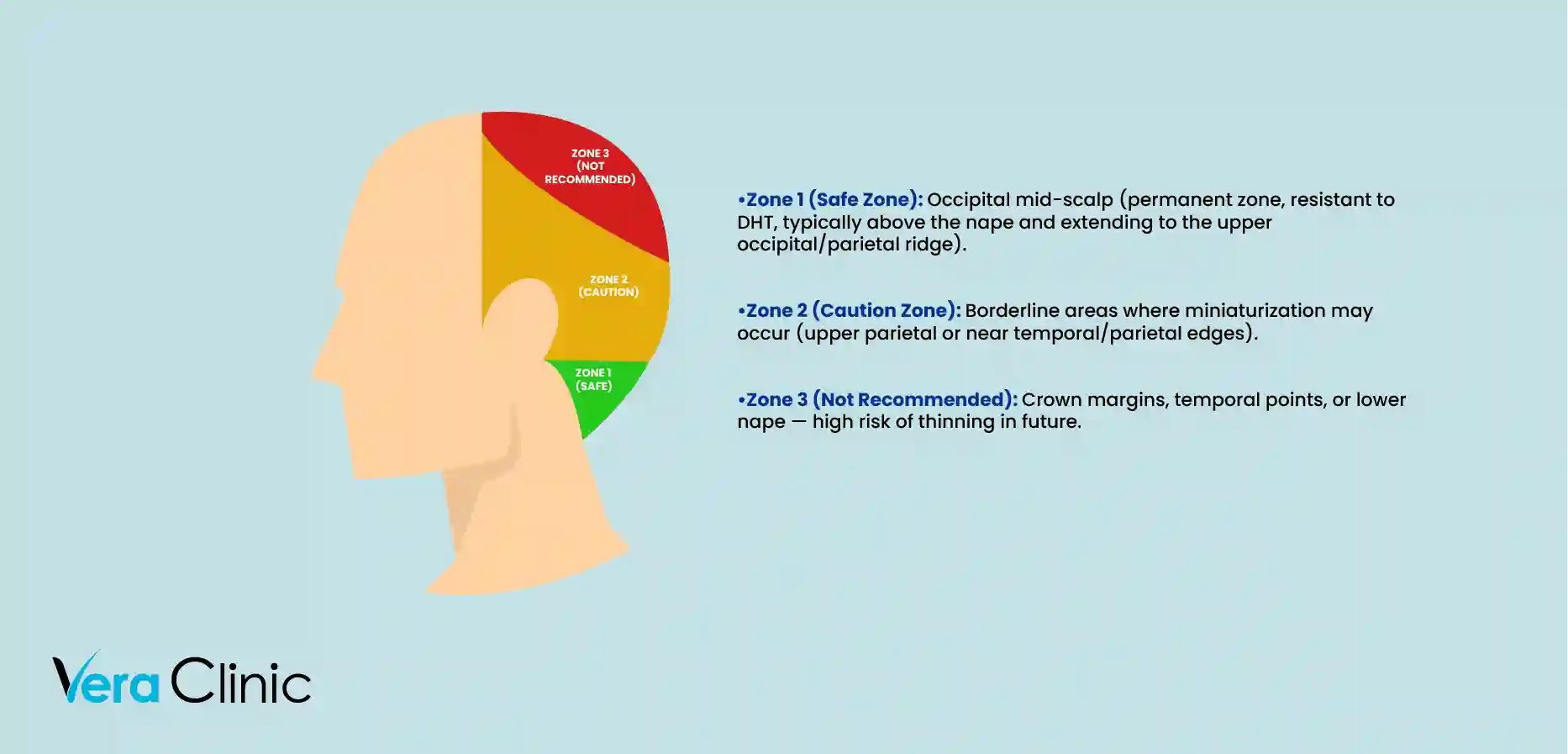 Hair Transplant Donor Area Inforgraphic Head Zones