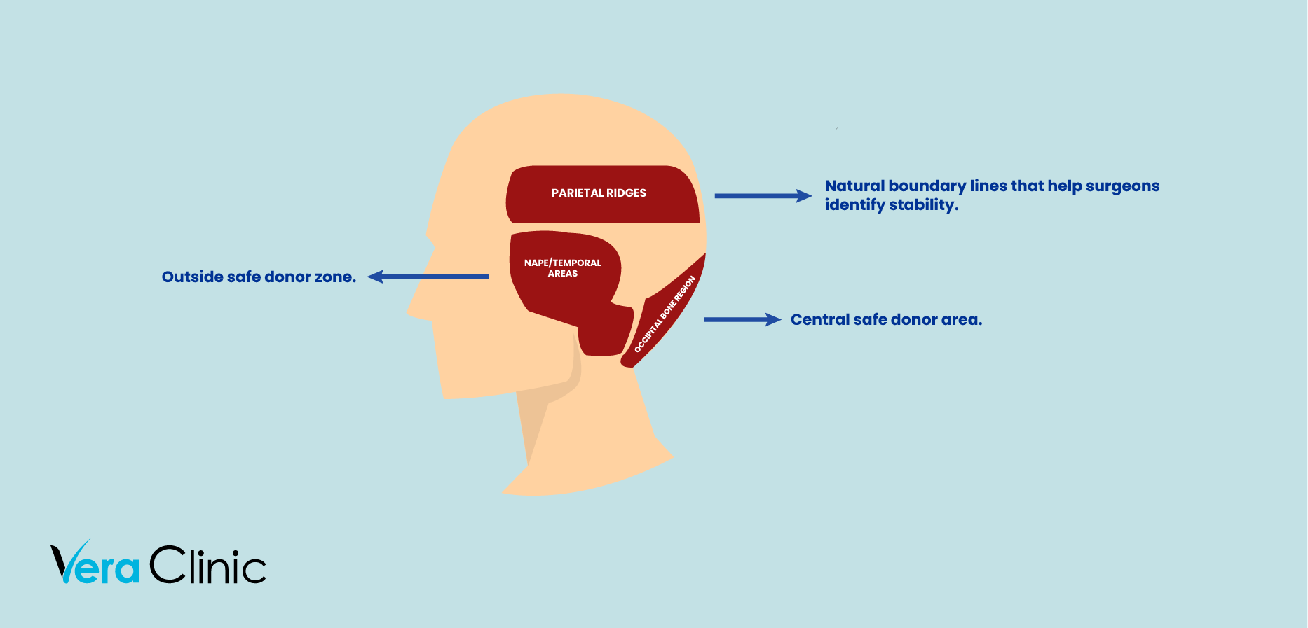 Why Is the Safe Donor Zone Crucial for Successful Hair Transplants