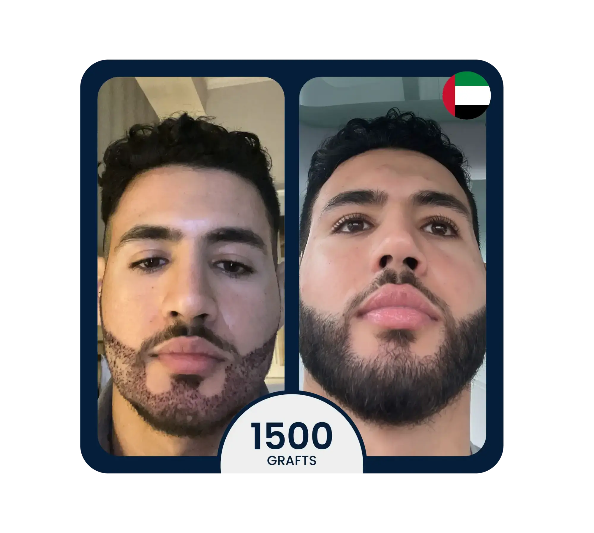 After beard transplant showing full and even facial hair coverage (front view).
