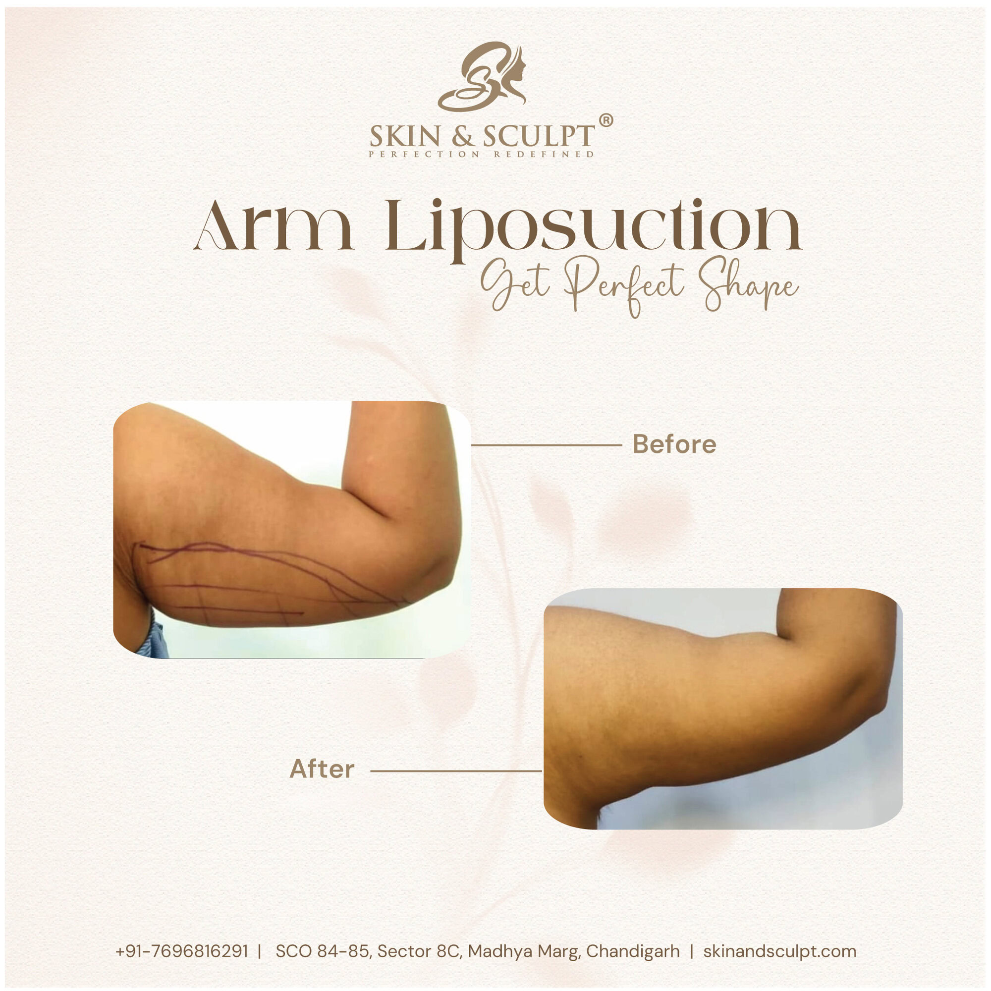 You are currently viewing Liposuction Recovery: What to Expect in the Days, Weeks, and Months Following Surgery.