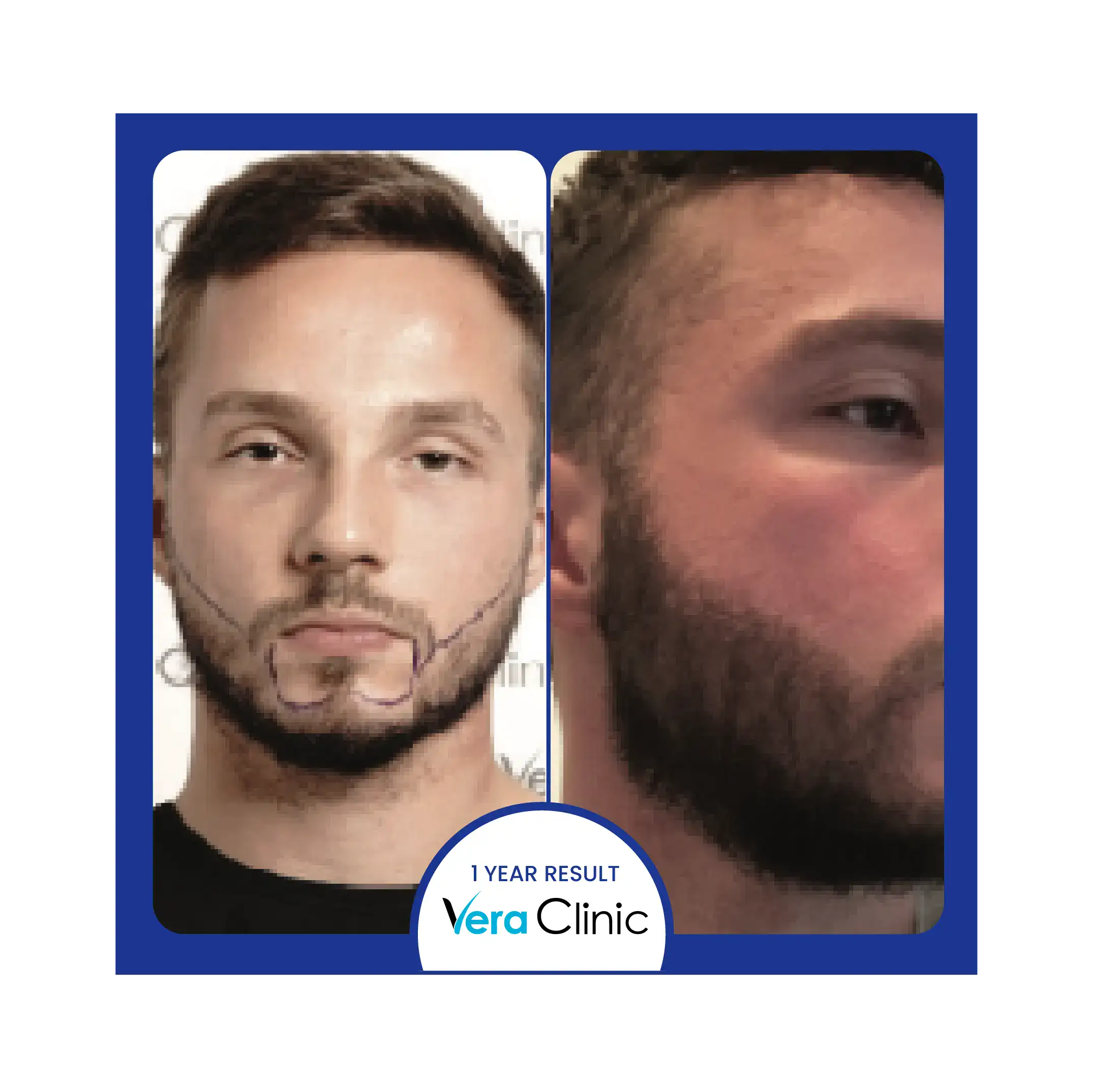 Beard surgery before and after set thin jawline density before FUE in Turkey