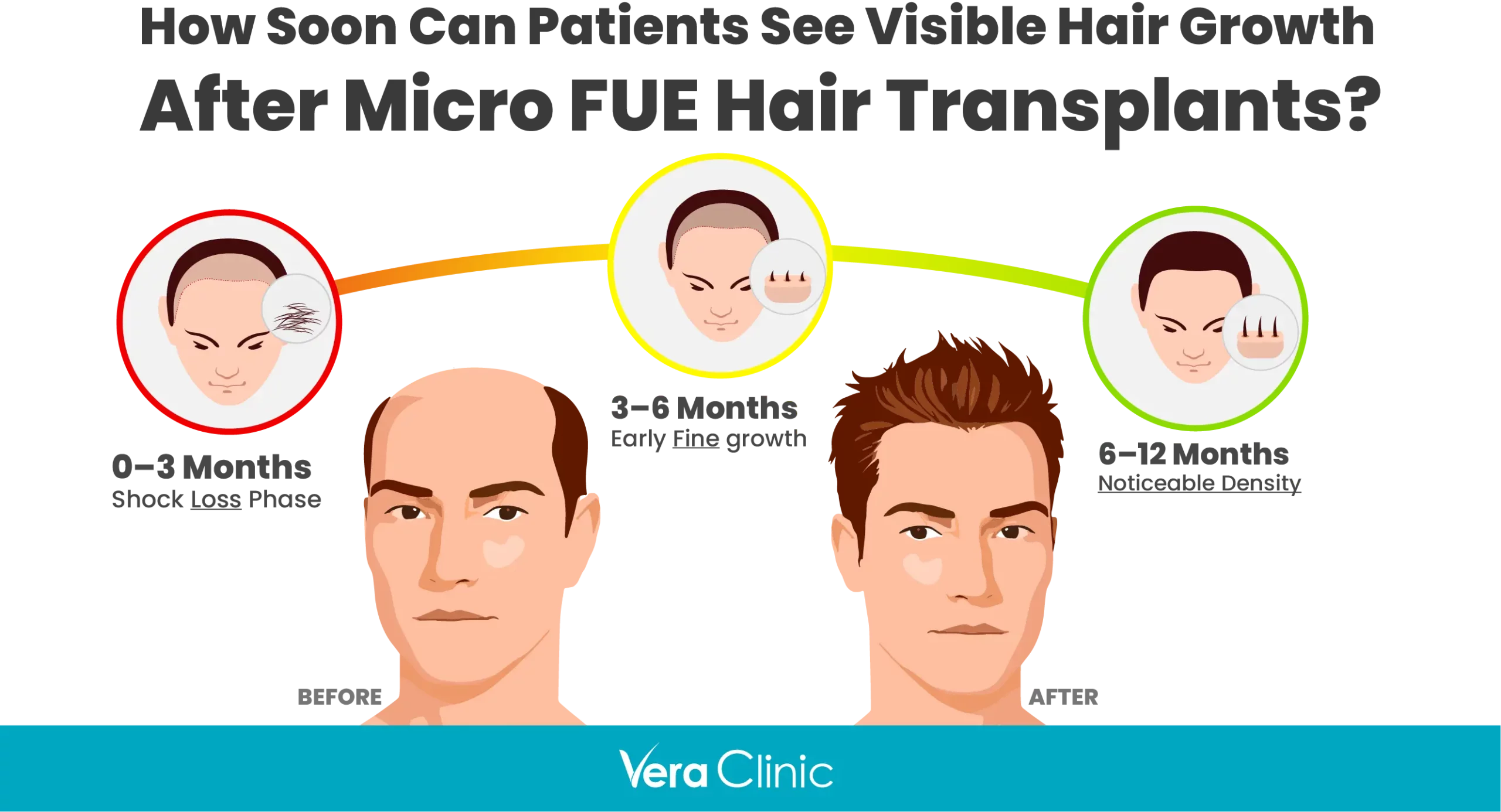 How Soon Can Patients See Visible Hair Growth After Micro FUE Hair Transplants