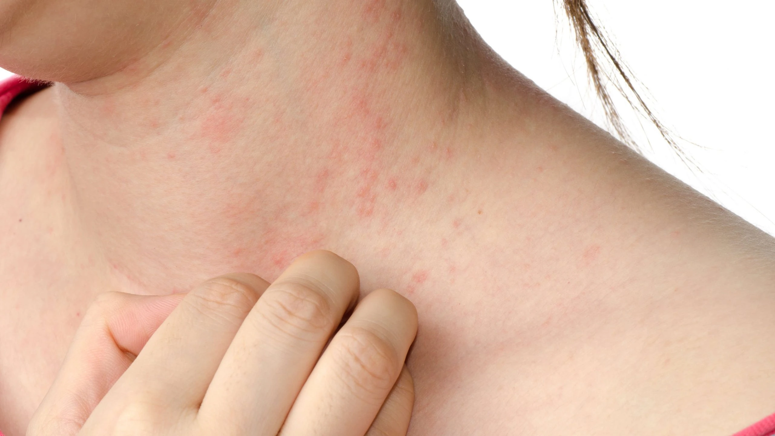 What Are The Signs Of A Severe Allergic Reaction? | iCare ER & Urgent Care 553089 scaled iCare ER & Urgent Care