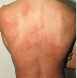 Read more about the article URTICARIA