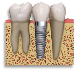 dental implants - titanium implant