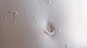 Read more about the article MOLLUSCUM CONTAGIOSUM