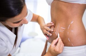 Read more about the article Is Liposuction Worth It? Find Out Why!