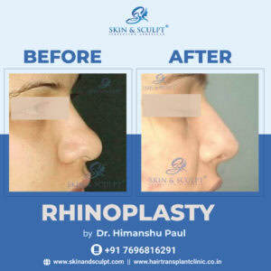Rhinoplasty in Chandigarh