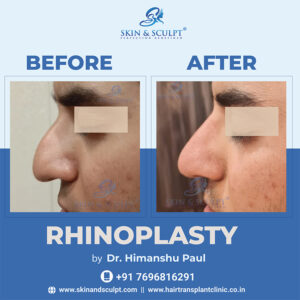 Rhinoplasty in Chandigarh
