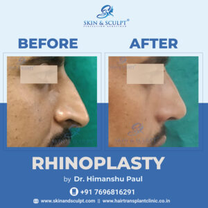 Rhinoplasty in Chandigarh