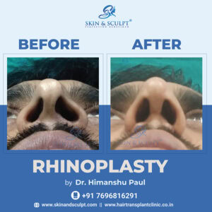 Rhinoplasty in Chandigarh