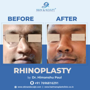 Rhinoplasty in Chandigarh