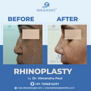 Rhinoplasty in Chandigarh