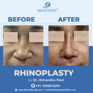 Rhinoplasty in Chandigarh
