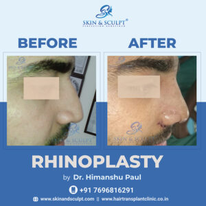 Rhinoplasty in Chandigarh