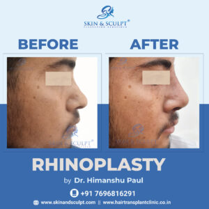 Rhinoplasty in Chandigarh