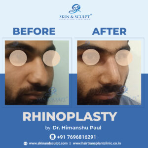 Rhinoplasty in Chandigarh