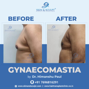 Gynecomastia In Chandigarh By Dr. Himanshu Paul