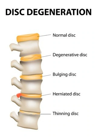 Disc degeneration chart showing a normal disc, degenerative disc, bulging disc, herniated disc, and a thinning disc