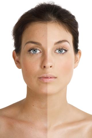 You are currently viewing PHOTOFACIAL