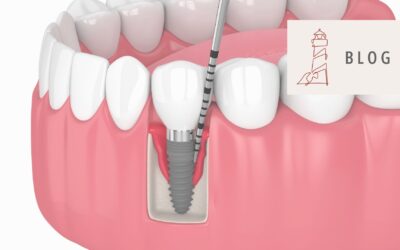Möglichkeiten der Abrechnung für die Behandlung einer Periimplantitis