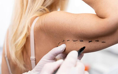 Top 7 Reasons to Get an Arm Lift After Weight Loss