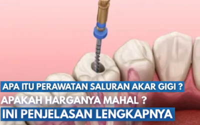 Beginilah Proses Perawatan Saluran Akar Gigi: Kenapa Biayanya Mahal dan Apakah Benar Menyakitkan?