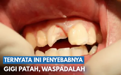 Terbukti Ampuh! 6 Cara Mengatasi Gigi Patah Sesuai Tingkat Kerusakannya