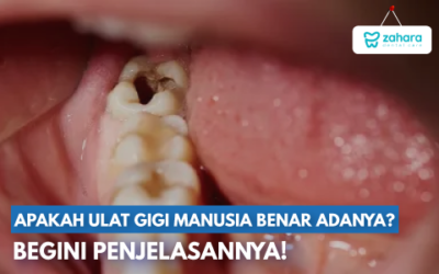 Benarkah Ada Ulat Gigi Manusia yang Menyebabkan Masalah Serius di Mulut? Begini Penjelasannya!