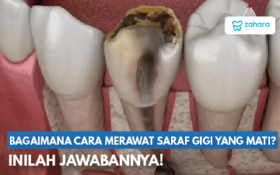 Saat Saraf Gigi Mati, Apa yang Sebenarnya Terjadi dan Haruskah Dicabut?