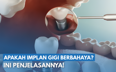 Hati-Hati! Inilah Bahaya Implan Gigi Apabila Dilakukan Tidak Sesuai Prosedur
