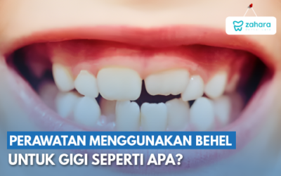 6 Bentuk Gigi Manusia yang Perlu Melakukan Perawatan Behel