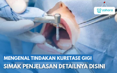 Apa Itu Tindakan Kuretase Gigi? Simak Penjelasan Detailnya Berikut Ini!