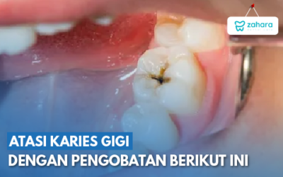 Inilah 5 Pengobatan Karies Gigi yang Bisa Anda Coba untuk Mengatasinya