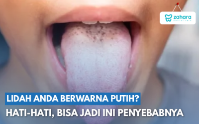 6 Penyebab Lidah Berwarna Putih dan Cara Mengatasinya