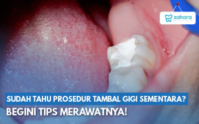 Mengenal Tambal Gigi Sementara: Bahan, Daya Tahan, dan Cara Merawatnya